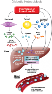 diabetic ketoacidosis illustration