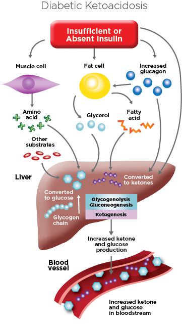 diabetic ketoacidosis illustration