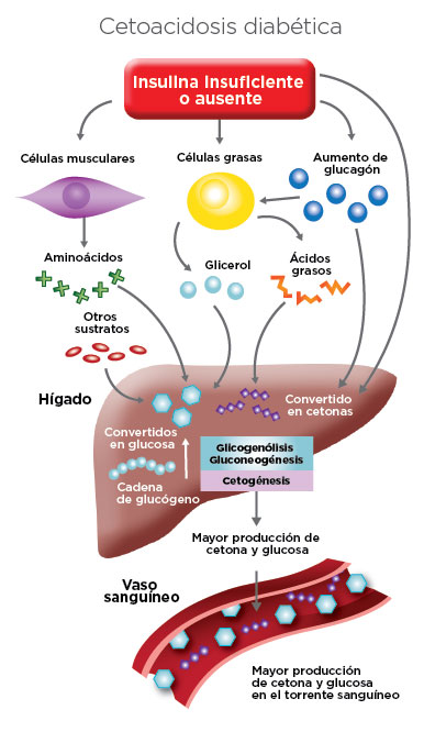 Cetoacidosis diabética